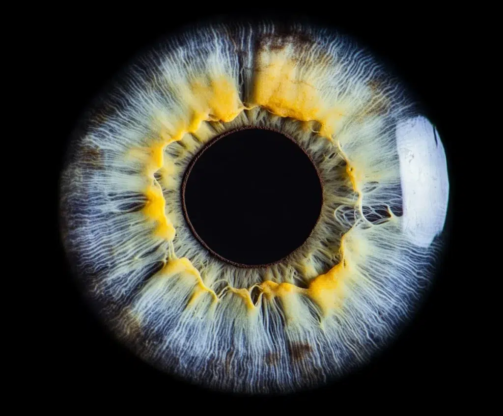 Синдром сухого ока